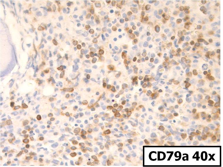 CD79a 40x, Smaller blasts are positive for CD79a